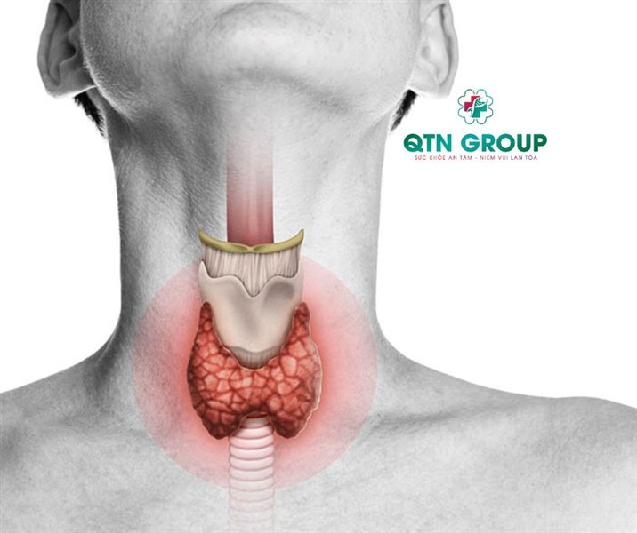 Bệnh Basedow (Graves) là gì? Triệu chứng và nguyên nhân của Basedow?