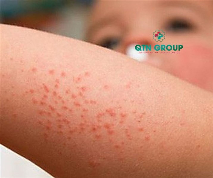 Sốt xuất huyết là gì? Dùng gì để Tăng tiểu cầu và nhanh khỏi sốt xuất huyết?