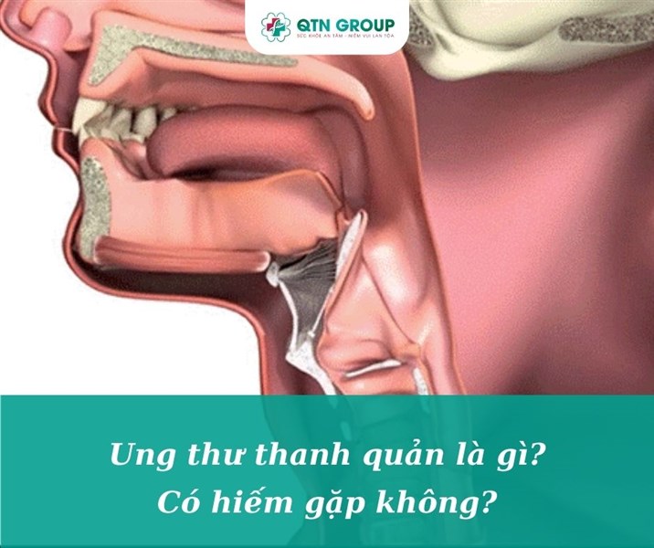 Ung thư Thanh quản là gì? Có hiếm gặp không?