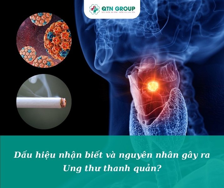 Dấu hiệu nhận biết và nguyên nhân gây ra Ung thư Thanh quản? Những ai nên chú ý đến căn bệnh này?