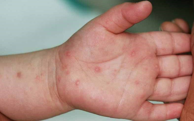 Bệnh tay chân miệng tăng 90% số ca mắc tại TP.HCM: Cần làm gì để giảm rủi ro?