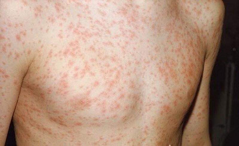 Ghi nhận thêm 2 trường hợp tử vong do sởi trong tuần qua: Hãy phòng tránh bệnh bằng những giải pháp đơn giản, hiệu quả cho cả người lớn và trẻ em