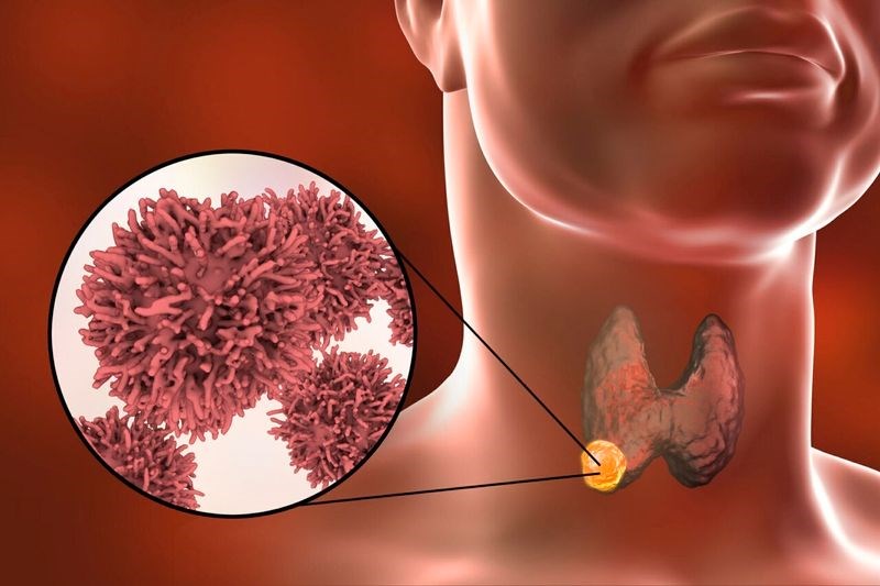 Ung thư tuyến giáp không thể coi là đại dịch! BS lý giải nguyên nhân