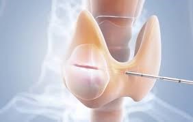 Đốt sóng cao tần trị u tuyến giáp: Vì sao các chuyên gia khuyên dùng?