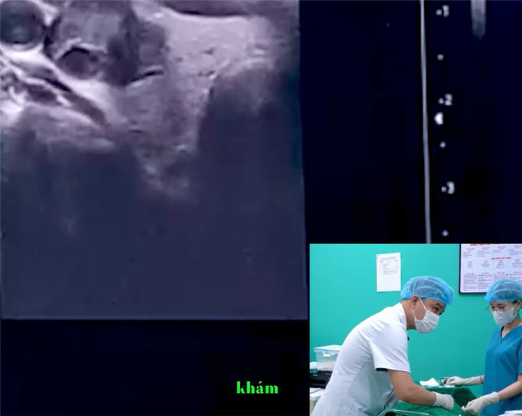 Livestream đốt sóng cao tần cho cô bệnh nhân 60 tuổi đến từ Hải Phòng