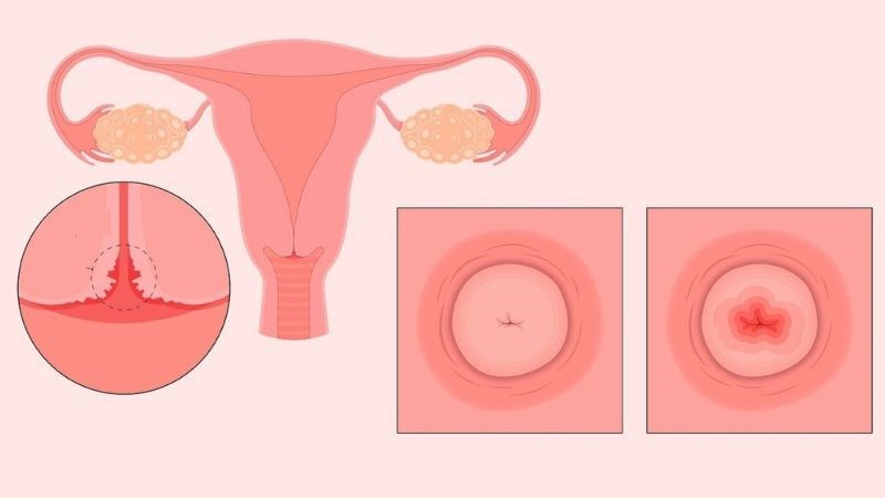 Chị em bị viêm lộ tuyến có HPV âm tính nên làm gì để tránh ung thư cổ tử cung?