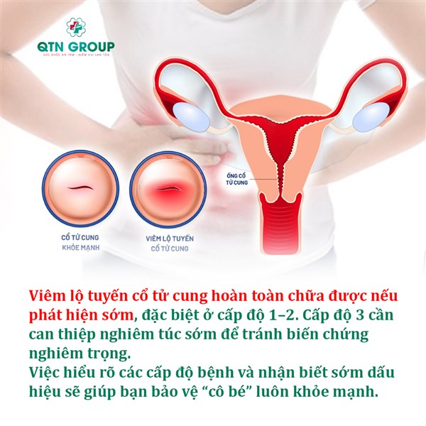 Các cấp độ của viêm lộ tuyến: Bạn đang ở cấp độ nào?