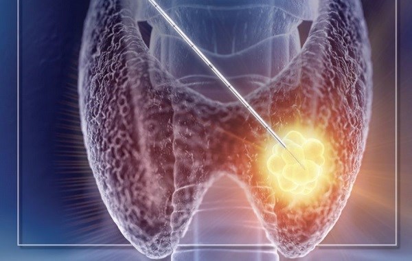 Dấu hiệu nhân tuyến giáp không tốt