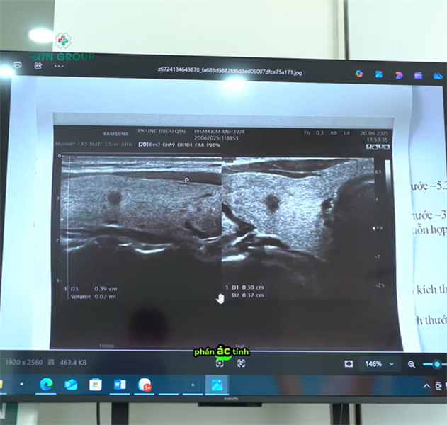 Bệnh nhân có nhân tuyến giáp giảm âm mạnh, trục dọc, bờ mép không đều xử lý thế nào?