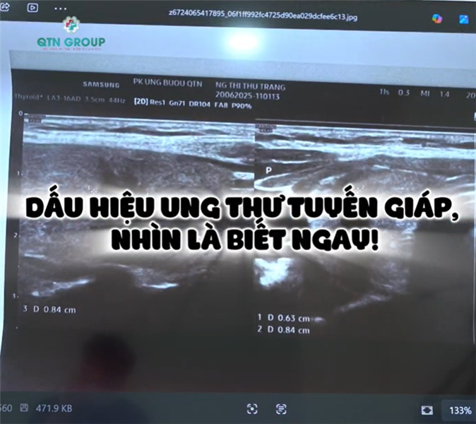 Dấu hiệu nhận biết ung thư tuyến giáp qua hình ảnh siêu âm