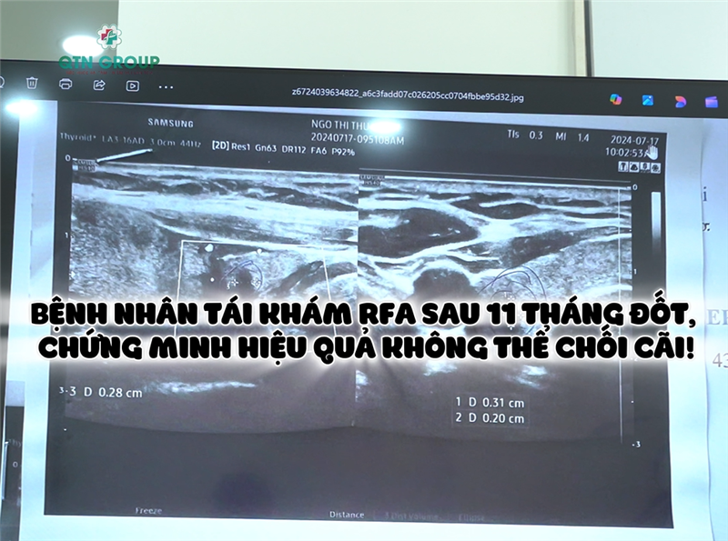 Kết quả siêu âm của bệnh nhân tái khám RFA sau 11 tháng