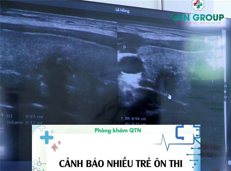 Có hiện tượng nuốt nghẹn, nhiều trẻ sau ôn thi THPT quốc gia đi khám thì đã bị K giáp