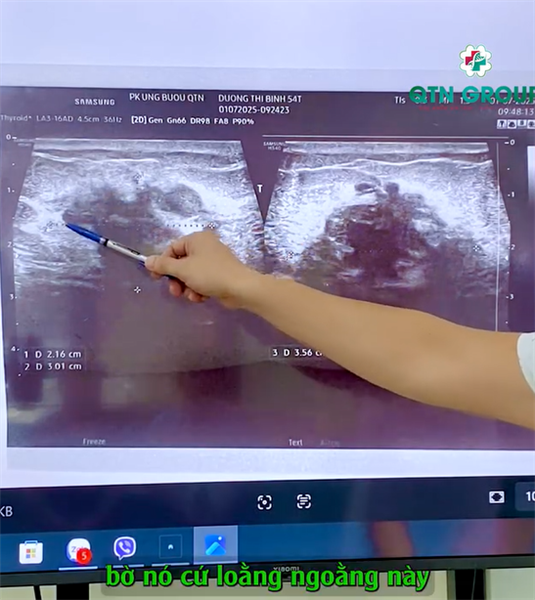 U vú có đặc điểm này 99% ung thư vú!