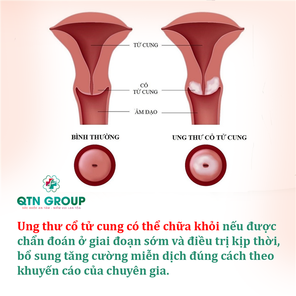 Ung thư cổ tử cung: Có thể chữa khỏi dứt điểm không?