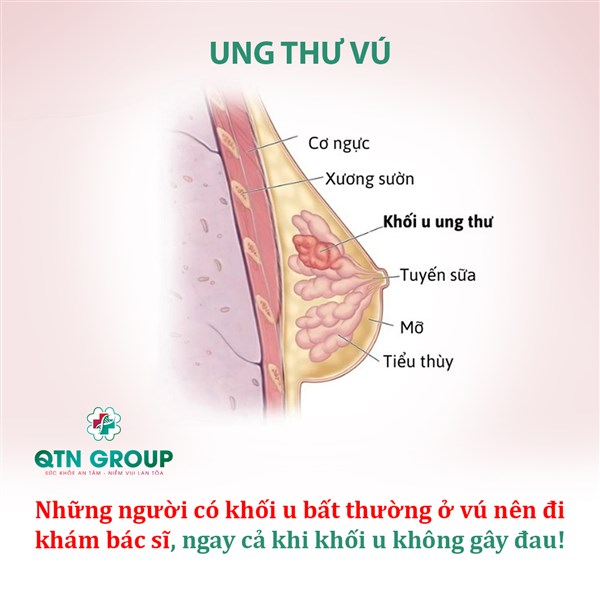 Các dấu hiệu, triệu chứng cảnh báo bệnh ung thư vú