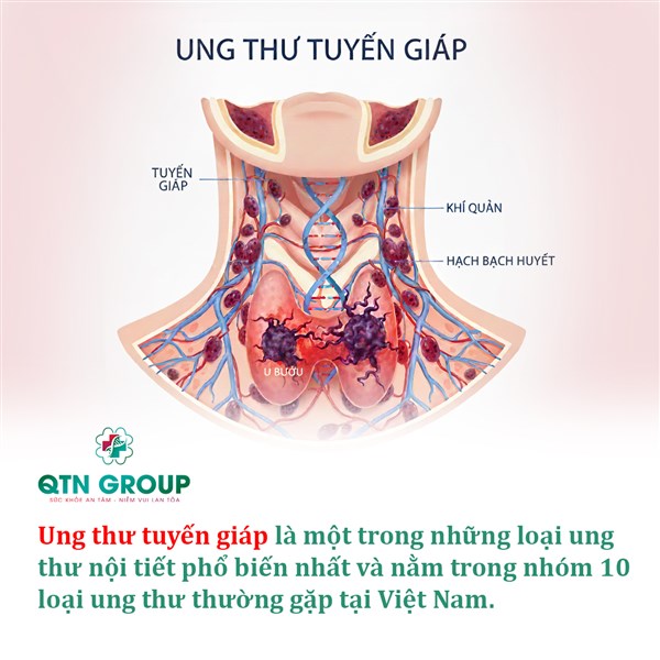Ung thư tuyến giáp phổ biến thế nào?