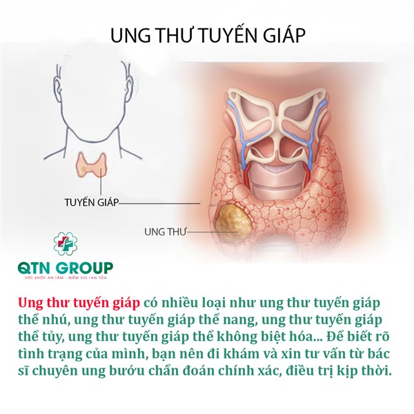 Ung thư tuyến giáp có những loại nào?