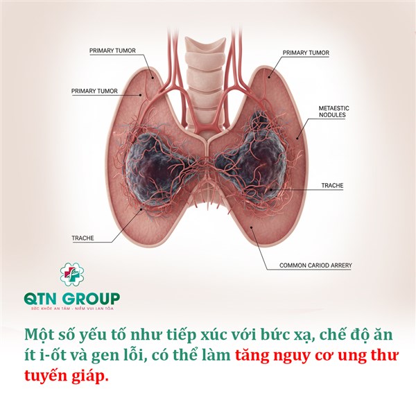 Nguyên nhân ung thư tuyến giáp