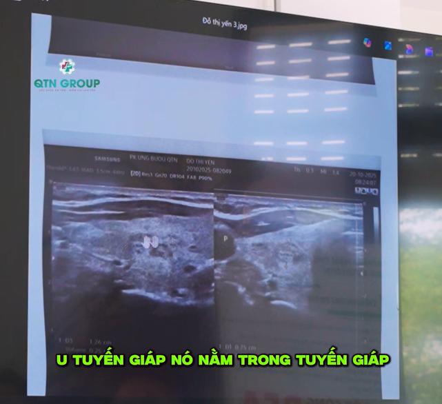 Dấu hiệu nhận biết u tuyến giáp ác tính qua hình ảnh siêu âm