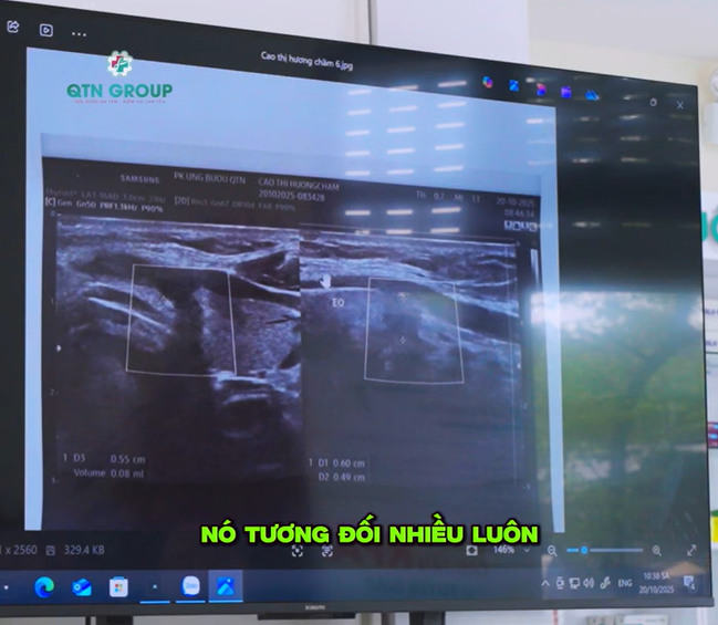 Theo dõi video BS Thái chia sẻ thường xuyên để nhận biết u tuyến giáp lành tính hay ác tính