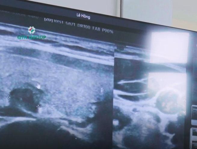 Phân biệt u lành - u ác, nang tuyến giáp trên hình ảnh siêu âm