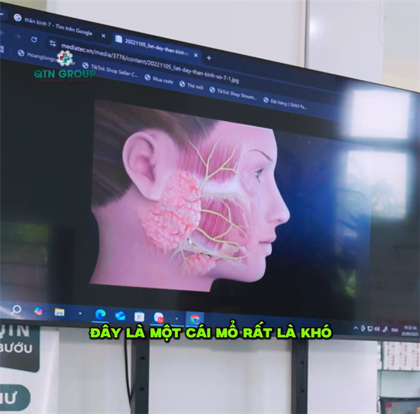 U tuyến nước bọt to 4cm nên xử lý thế nào? Cần lưu ý gì trước khi làm