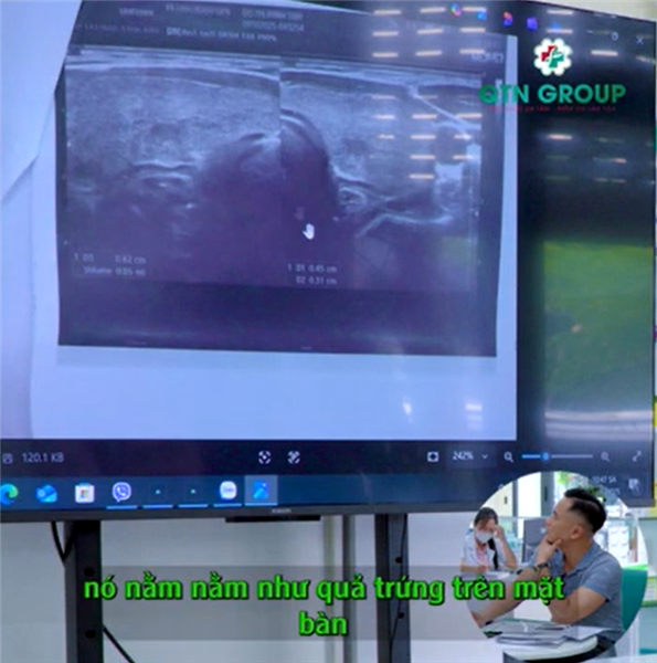 Nhận biết u tuyến giáp đáng lo dù nhân còn rất nhỏ