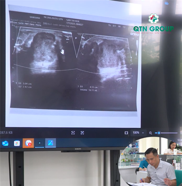 Phân tích khối u vú qua hình ảnh siêu âm