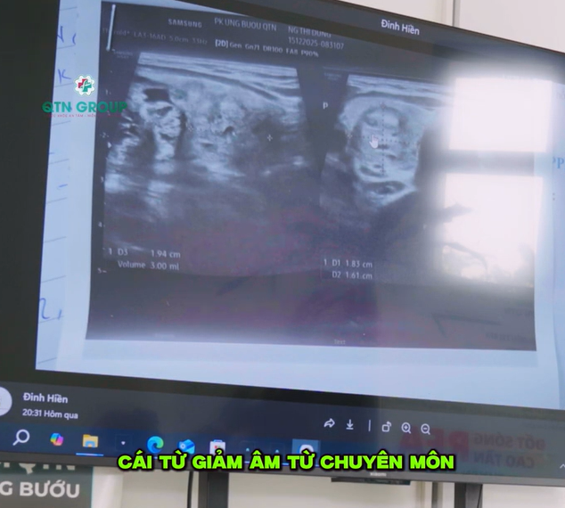 Nhận biết u tuyến giáp lành tính