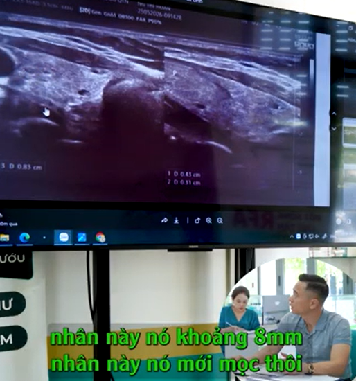Bất ngờ kết quả tái khám cho bệnh nhân đốt sóng cao tần sau 2 năm