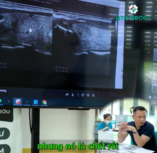 Hình ảnh siêu âm sau đốt RFA chứng tỏ bạn khỏi bệnh
