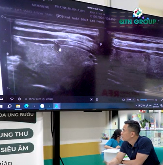 BS Thái phân tích một dạng u tuyến giáp cực nhỏ nghiêng hẳn ác tính, rất dễ bỏ sót tổn thương