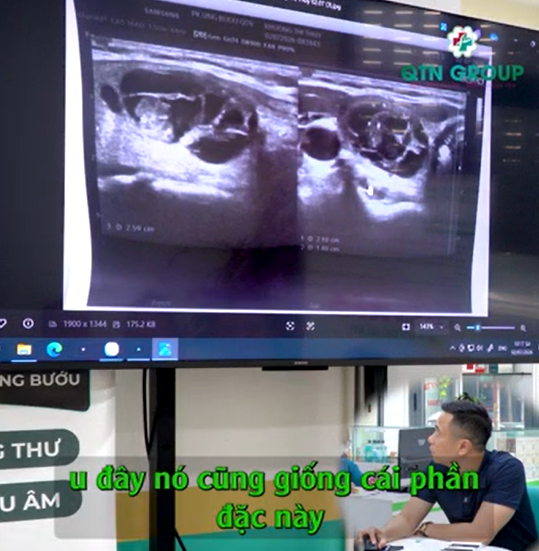 U rất nhỏ nhưng nhìn là biết ngay "ung thư rồi"