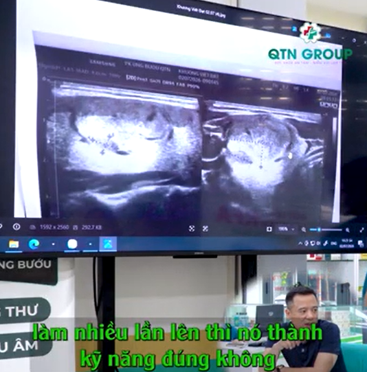 Đây là hình ảnh u tuyến giáp lành tính