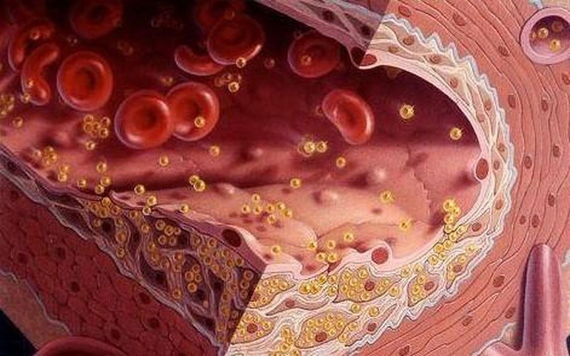 Mỡ máu tăng ở tuổi trên 60 có cần điều trị?