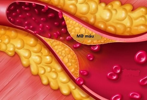 Mỡ máu chỉ hơi tăng có đáng lo? Nhiều người đang chủ quan vì nghĩ “không sao đâu”