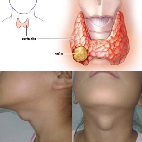 Tư vấn cho bệnh nhân có u tuyến giáp lành tính, đường huyết và mỡ máu đều cao